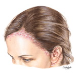Inverse Psoriasis