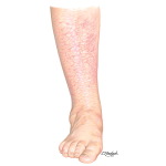 Asteatotic Eczema