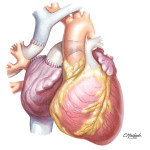 Tricuspid Atresia
