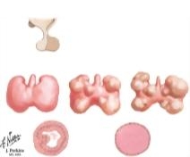 Etiology of Nontoxic Goiter