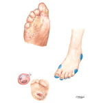Factors Predisposing to Foot Ulcers (Autonomic)