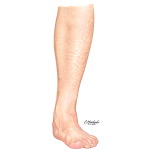 Ichthyosis Vulgaris