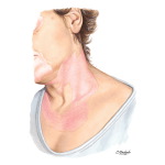 Vitiligo (Psoralan Bunning)
