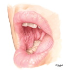 Buccal Lichen Planus