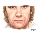 Perioral Dermatitis