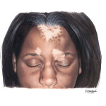 Vitiligo