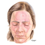 Tinea Facia
