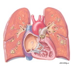 Substance Abuse and the Heart