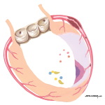 Acute Coronary Syndromes: Plaque Formation