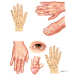 Differential Diagnosis of Arthritis In Hand