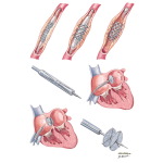 Interventional Approaches to Peripheral Arterial Disease
