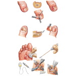 Common Infections of Foot