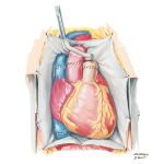 Transection of Aorta And Pulmonary Trunk