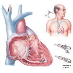Endomyocardial Biopsy