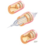 Mechanism of Balloon Angioplasty