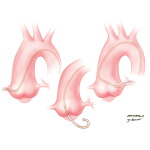 Left Heart Catheterization