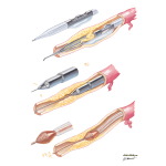 Atherectomy Techniques
