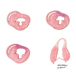 Types of Wall Motion (Normal and Abnormal)