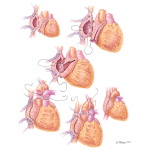 Technique of Orthotopic Biatrial Cardiac Transplantation