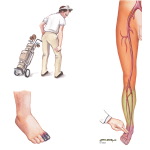 Lower Extremity Arterial Occlusive Disease