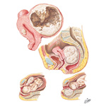 Myoma (Fibroid) III - Cystic Degeneration, Incarceration, Obstruction
