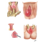 Vulvitis II - Gonorrhea