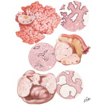 Surface Papilloma, Serous Adenofibroma, Serous Cystadenofibroma