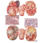 Carcinoma - Primary Cystic Carcinoma, Primary Solid Carcinoma, Secondary Ovarian Carcinoma