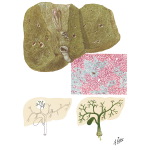 Biliary Cirrhosis