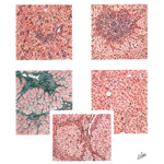 Viral Hepatitis IV - Sequelae of Hepatitis (Chronic Nonfatal Hepatitis)