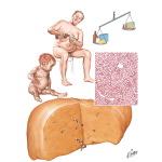 Nutritional Liver Diseases