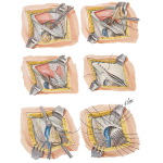 Hernia II - Femoral Hernia