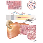 Infectious Mononucleosis, Yellow Fever