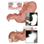 Peptic Ulcer III - Chronic Gastric Ulcer