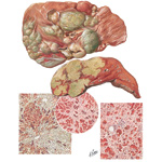 Viral Hepatitis III - Subacute Fatal Form