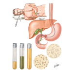 Duodenal Drainage of Meltzer and Lyon