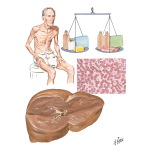 Nutritional Liver Diseases