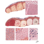 Acute Toxemia of Pregnancy IV - Placental Lesions in Preeclampsia and Eclampsia, Infarcts