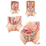 Ectopic+testis