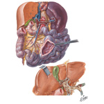 Vascular Disturbances II - Portal Vein