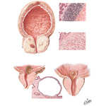 Infarct, Retention Cyst
