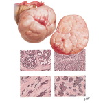 Carcinoma - Primary Cystic Carcinoma, Primary Solid Carcinoma, Secondary Ovarian Carcinoma