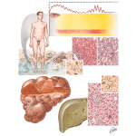 Spirochetal Infections - Weil's Disease, Syphilis