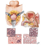 Carcinoma of Prostate III - Early, Estrogen and Castration Effects