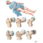Common Fractures of Proximal Femur