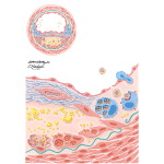 Atherogenesis: Fibrous Plaque Formation