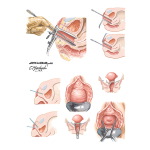 Speculum Examination