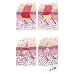 Healing of Excised Skin Wound
