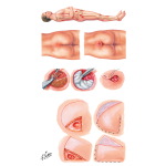 Pressure Ulcer