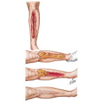 Delayed Posttraumatic Osteomyelitis in Diabetic Patient